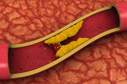 Cum de a reduce colesterolul în stilul de viață al sângelui și nutriția adecvată