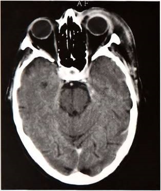 Fistula arteriovenoasă carotidă arteriovenoasă este o afecțiune patologică