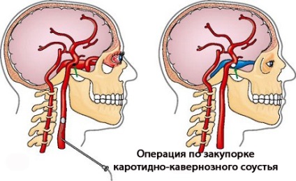 Anastomoza carotidă cavernosă la copii - simptome de boală, prevenire și tratament