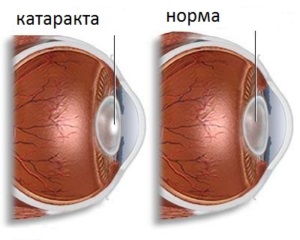 Cataracta în diabet zaharat - simptome și tratament