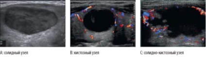 Chistul și nodul tiroidian cauzează dezvoltarea patologiilor, cursul și diferențele acestora
