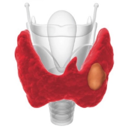 Chistul și nodul tiroidian cauzează dezvoltarea patologiilor, cursul și diferențele acestora