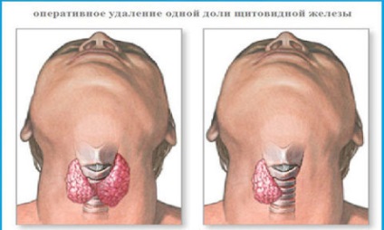 Chistul și nodul tiroidian cauzează dezvoltarea patologiilor, cursul și diferențele acestora