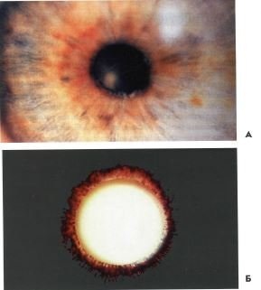 Tomografia coerenței optice clinice a irisului