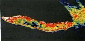 Tomografia coerenței optice clinice a irisului