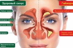 Tratamentul sinusurilor maxilare