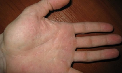 Tratamentul ciupercilor pe unghiile picioarelor și mâinilor