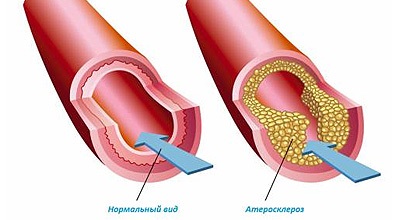 Tratamentul prostatitei