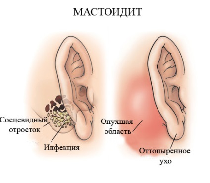 Mastoidita la copii - simptome ale bolii, prevenirea și tratamentul mastoiditei la copii, cauze