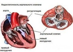 Insuficiența valvei aortice - tratament, grad