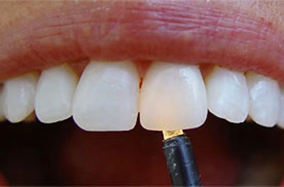 A fogászati ​​implantáció új technológiái