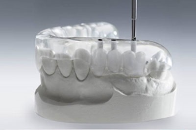 Tehnologii noi de implantare dentară