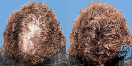 Prezentare generală a minoxidilului pentru accelerarea creșterii părului de minoxidil