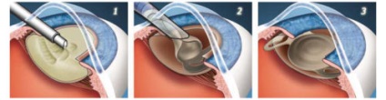 Operații de înlocuire a lentilei artificiale a ochiului în cataractă