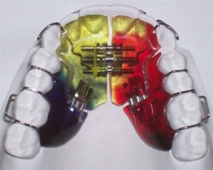 Ortodonție braces, plăci - avicenna-st Dnepropetrovsk