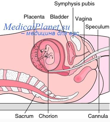 Complicațiile transfuziilor intravenoase intravasculare de sânge