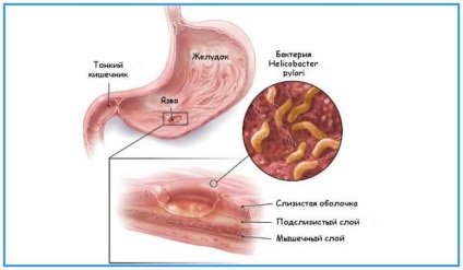 Complicații ale ulcerului peptic al stomacului și al duodenului