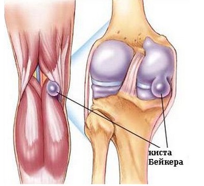 Simptomele osteoartritei și tratamentul în orice etapă