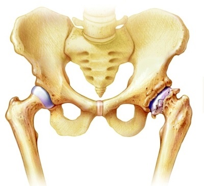 Simptomele osteoartritei și tratamentul în orice etapă