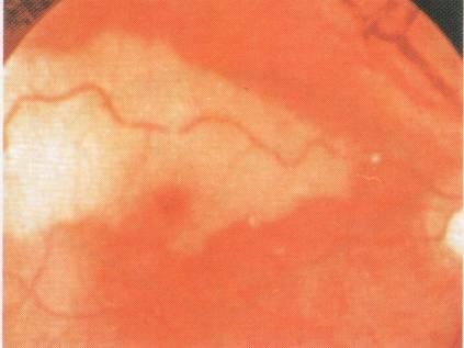 Tulburări circulatorii acute în vastele retinei