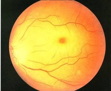 Tulburări circulatorii acute în vastele retinei