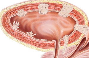 Papilomul vezicii urinare - fotografii, cauze, simptome, tratament