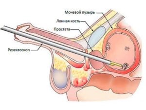Papilomul vezicii urinare - fotografii, cauze, simptome, tratament