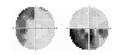 Metode perimetrice (computerizate, statice), indicații, clinici unde