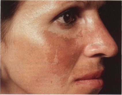 Pete pigmentate pe fața cauzei apariției și tratamentului la femei