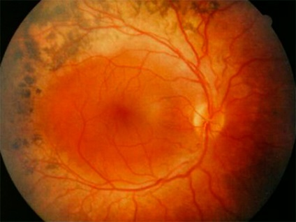 Retinita pigmentară - degenerarea pigmentară a retinei și tratamentul acesteia