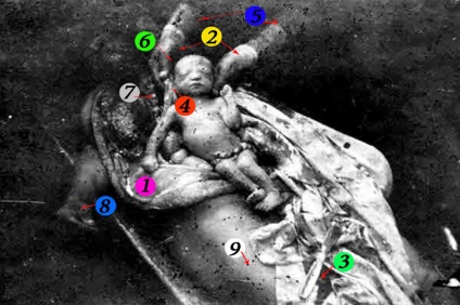 Fetus extras din uterul rupt al mamei