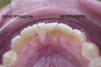 Avantajele și dezavantajele curățării dintelui laser sunt esența procedurii de îndepărtare a tartrului prin laser