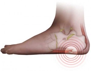 De ce tocurile picioarelor provoacă durere, simptome, diagnostic, tratament