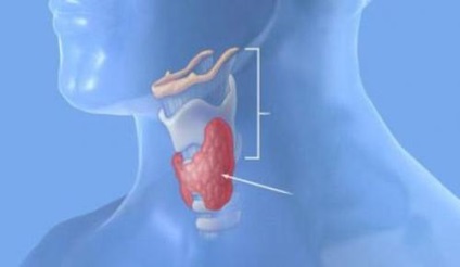 A pajzsmirigy csökkentése - a hypothyreosis tünetei és kezelése