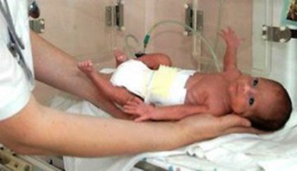 Avortul postnatal uciderea nou-născuților sau dacă copilul are dreptul la viață, economic