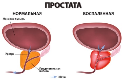 prostatita și adenom de prostată