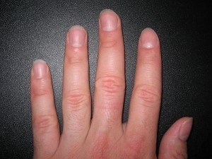 Cauzele bolilor de unghii - abces, puncte albe, deformare