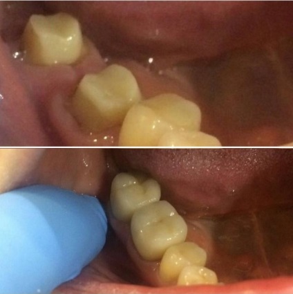 Inserția protetică este utilizată atunci când coroana dintelui este ruptă de la 30% la 50%