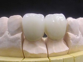 A fogak protetikája a cermet, mint a protézis, klinikai garanciát vállal
