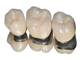 Este stabilită proteza dinților cu cermet ca proteză, garantul clinicii