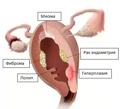 Cancerul uterului - simptome, cauze