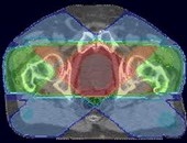 Cancerul de prostată - Terapia prin radiații