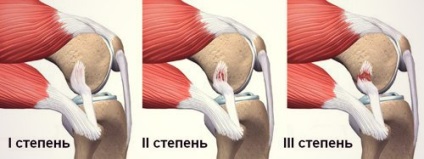 Ruptura ligamentelor articulației umărului, simptome, tratament