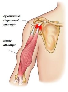 Reabilitarea ruperii tendoanelor bicepsului, o nouă etapă