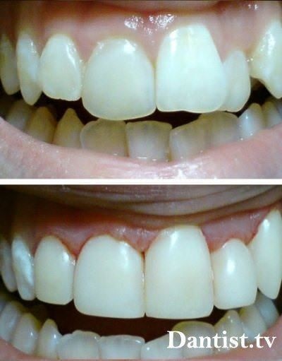 Restaurarea prețului și a fotografiilor pentru dinții curbate