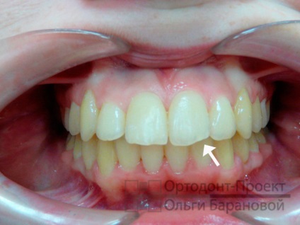 Restaurarea dinților anteriori după corecția mușcăturii