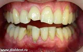 Restaurarea dinților anteriori după corecția mușcăturii