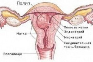 Simptomele și tratamentul polipilor uterini fără intervenție chirurgicală