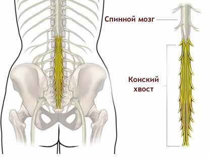 синдром Cauda Equina причинява симптомите и лечението