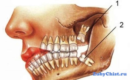 Câți dinți de înțelepciune poate avea o persoană?